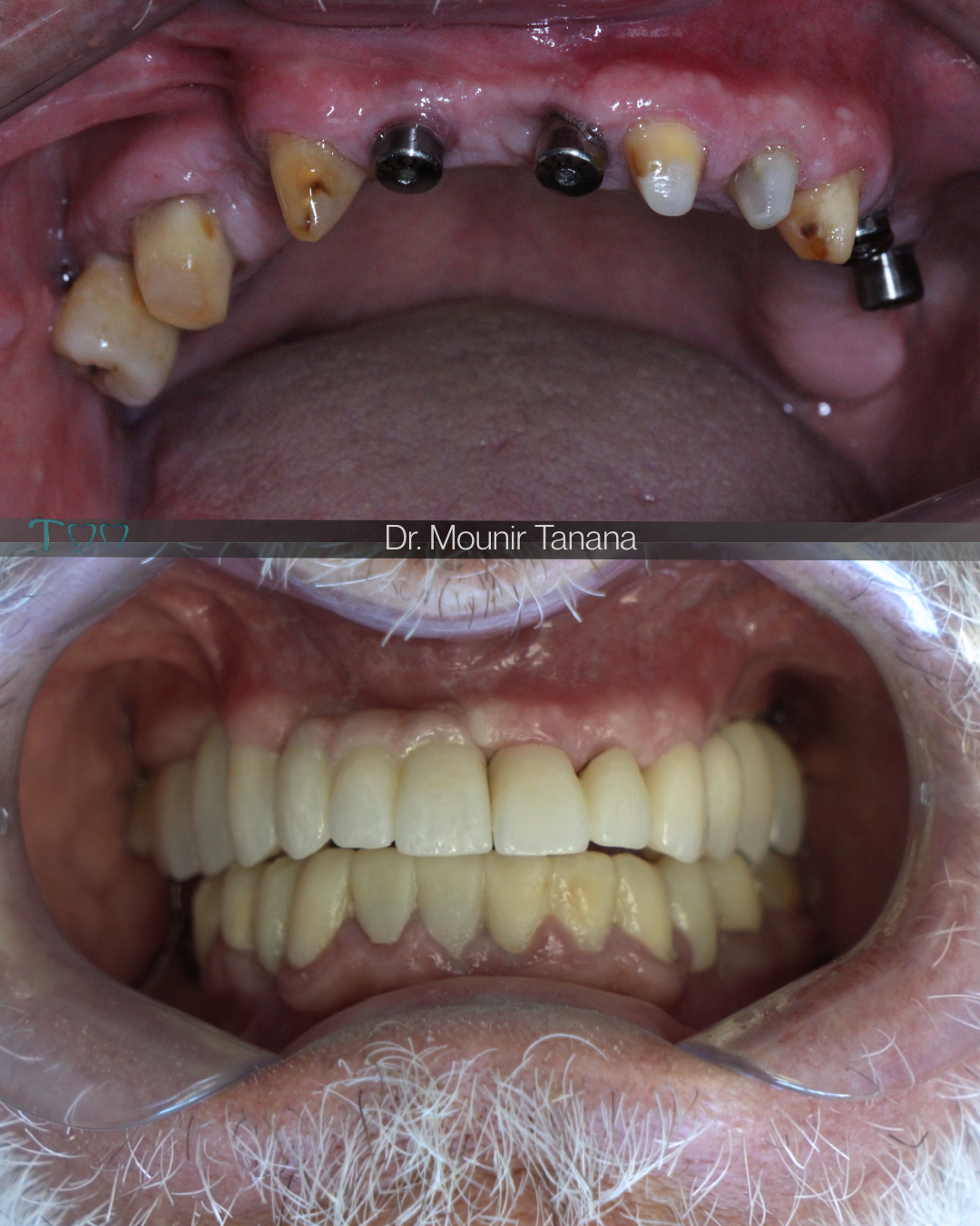 implant dentaire rabat